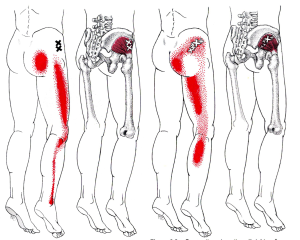 Referral patterns of Gluteus Minimus.  A lot like sciatic pain!